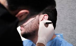 Beard Transplant Chicago