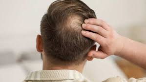 Male Pattern Baldness Treatment India