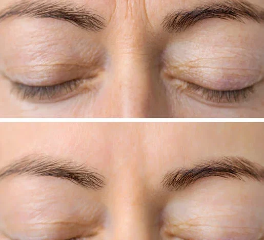 Best Hair Botox Treatment