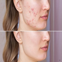Acne Scar Removal Treatment in Kolkata